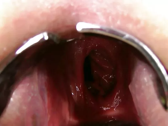Iskay kuti anal puñuy, prolapso, qhapaq wasipi ruwasqa espejo gaping.